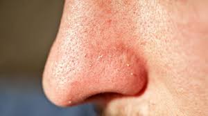 EXCESS SEBUM